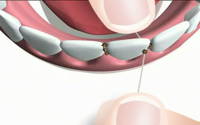 miradent Mirafloss® chx-Tape 20m
