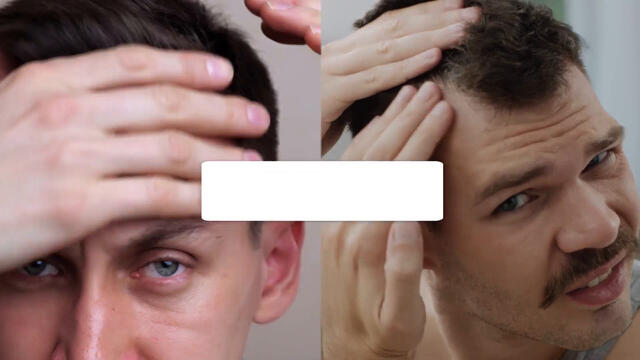 Minoxidil DoppelherzPharma Männer 50 mg/g Schaum zur Anwendung auf der Haut (Kopfhaut)